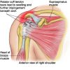 Rotator Cuff Injuries ro_c_tea